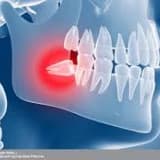 Gömülü 20 yaş dişi cerrahisi