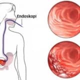 Endoskopik ultrasonografi