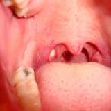 Bademcik taşı (tonsillolith)