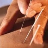 AKUPUNKTUR İLE TEDAVİ