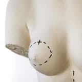 Meme Estetiği | Meme Büyütme Ameliyatı | Silikon Protez