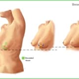 Meme Küçültme Estetiği Nasıl Yapılıyor?