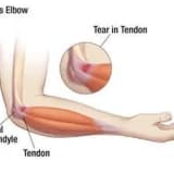 Tenisçi dirseği ve tedavisi