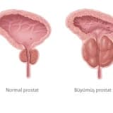 Prostat Biyopsisi Nedir?