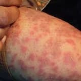 Biorezonans Metodu ile  Alerji Tedavisi