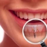 DENTAL (DİŞ ) İMPANTLAR NEDİR?