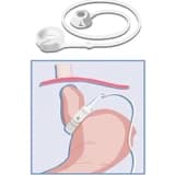 Mide Bandı Ameliyatı