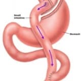 Mide by-bass Ameliyatı