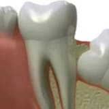 20 yaş dişleri neden çekilir , çekim sonrası neler yapılmalıdır