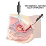 Koryon vilüs örneklemesi, CVS