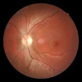 KALITIMSAL OPTİK SİNİR HASTALIKLARI ve Sebepleri