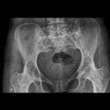 ANKİLOZAN SPONDİLİT (AS) HASTALARI İÇİN YAŞAM İPUÇLARI