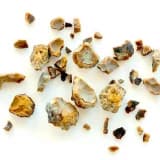 Böbrek taşı nedir? belirtileri nelerdir? nasıl oluşur? tedavisi nedir? tedavi olmazsa ne olur?