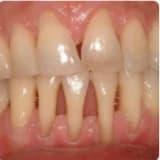 Diş Eti Çekilmesi, Diş Eti Kanaması (Periodontoloji)