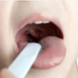 Adenoid Vejetasyon Hakkında