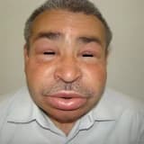 Allerjiyle karışan nadir bir hastalık: Herediter anjiyoödem