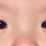 Bebeklik çağı göz kaymaları tipleri nelerdir? Yalancı şaşılık nedir?