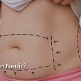 Liposuction ve Liposuction Olurken Bilinmesi Gerekenler!