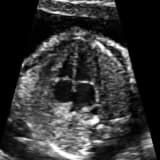 Bir muayene bulgusu olarak ÜFÜRÜM nedir?