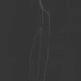 Karbondioksit Anjiyosu, Böbrek Yetmezliği ve Alerji Hastalarına Avantaj Sağlıyor