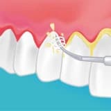 Diş Taşı Temizliği Nedir ?