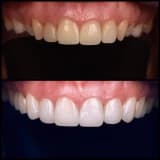 Yaprak Porselen / Lamine