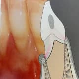 Diş eti çekilmesi neden olur?