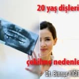 20 yaş dişlerinin çekilme nedenleri ?