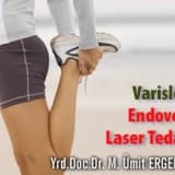 Varislerde endovenöz lazer tedavisi