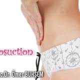Liposuction (yağ alma)