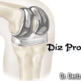 Diz protezi,