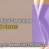 Bacak kılcal damarlarının lazer ile tedavisi