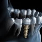 Diş implantları !