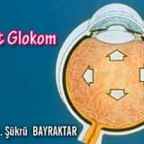Akut Glokom