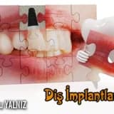 Diş implantları!