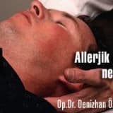 Allerjik rinit nedir? tedavisi nasıl olur?