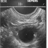 Yumurtlamanın artırılması (Kontrollü Over Stimülasyonu)