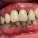 Dişeti hastalığı- periodontitis