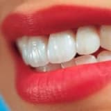 Diş ağartmada (bleaching) güncel bilgiler