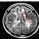 MS - MULTİPLE SKLEROZ - PLAK HASTALIĞI