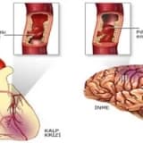 FELÇ (Stroke-İnme-Serebrovasküler olay)