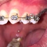 Ortodontik Tedavi Gören Hastalara Öneriler