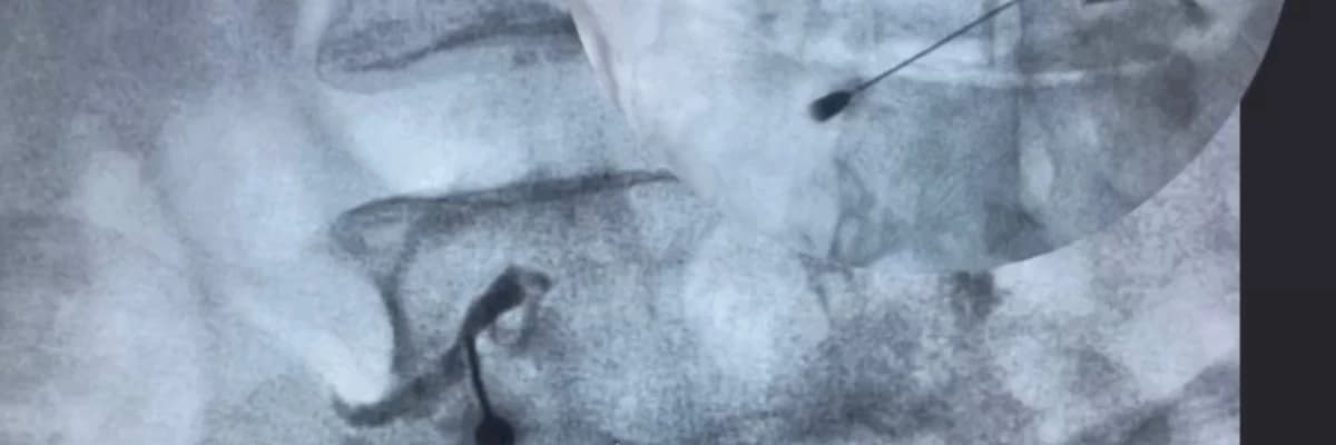 Bel Fıtığı Ağrılarında Ameliyatsız Kurtulmak Mümkün Olabiliyor !