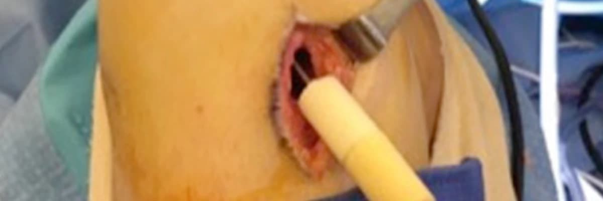 Management of bone deficiency in revision anterior cruciate ligament reconstruction