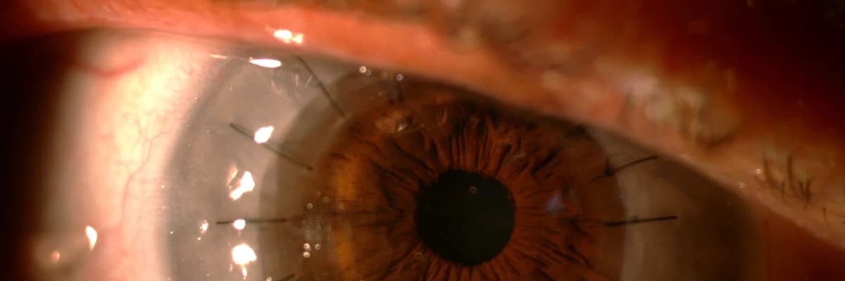 Kornea Nakli ve Yapay Kornea