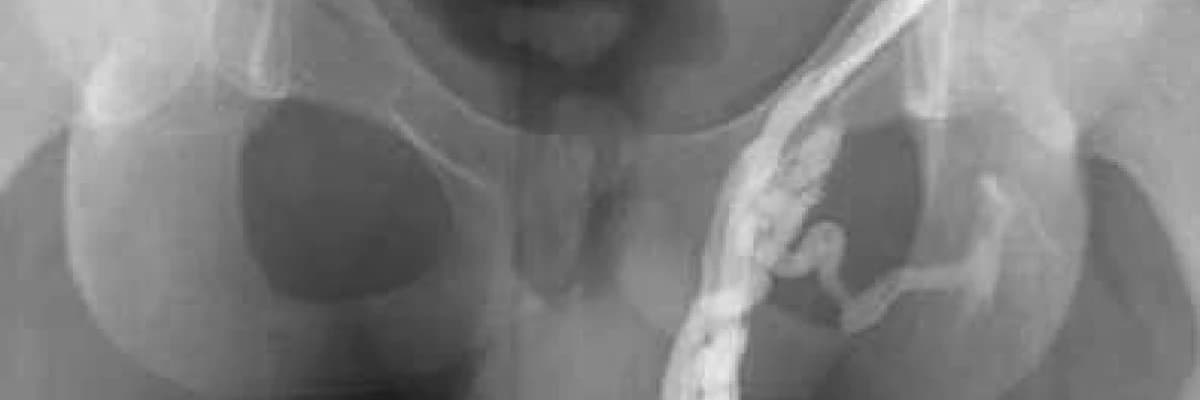 Varikosel mikrocerrahi tedavisi