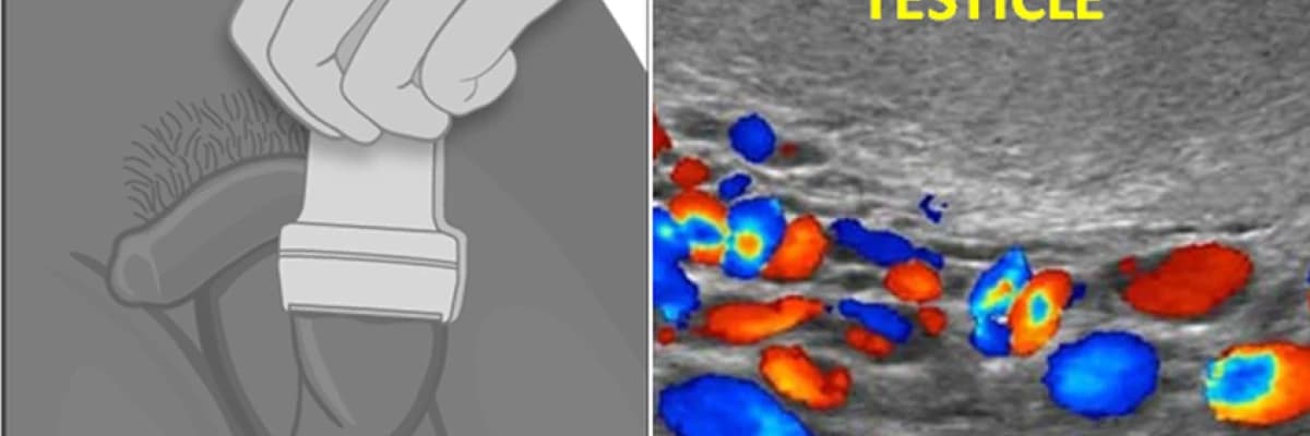 Varikosel mikrocerrahi öncesi tanı