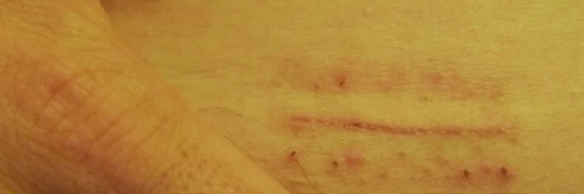 Varikosel mikrocerrahi başarısı