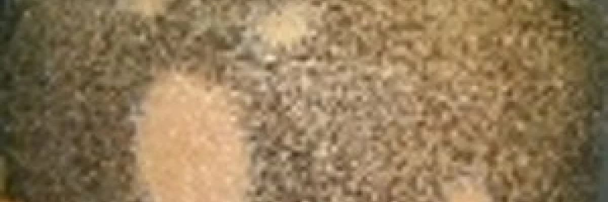 Saçkıran (alopesi areata)