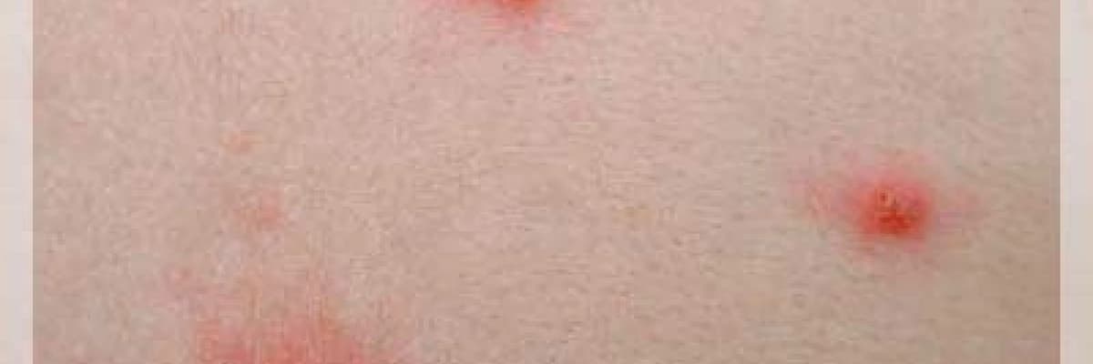 Gebelikte suçiçeği hastalığı tehlikeli mi?